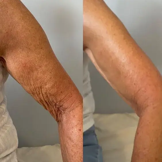 Before and after with XeiuC Collagen Oil